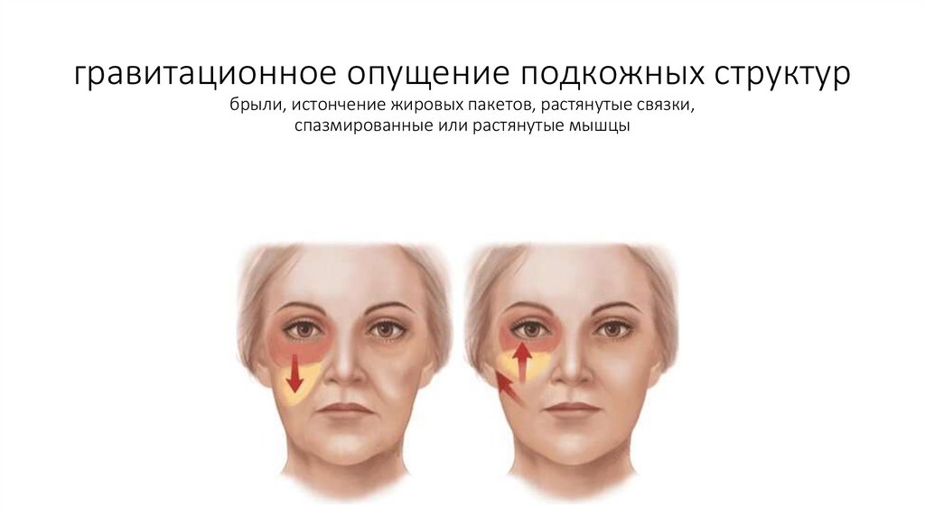 гравитационное опущение подкожных структур брыли, истончение жировых пакетов, растянутые связки, спазмированные или растянутые