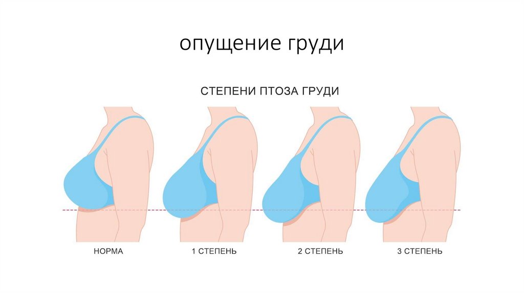 опущение груди