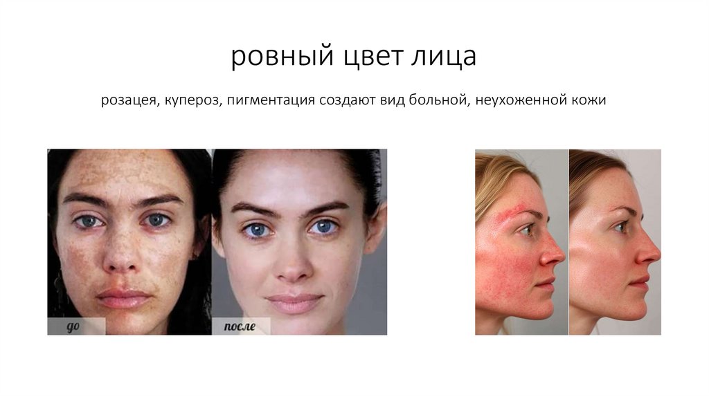 ровный цвет лица розацея, купероз, пигментация создают вид больной, неухоженной кожи