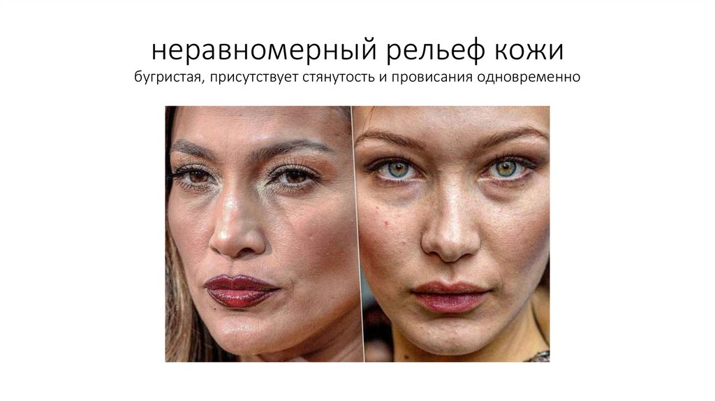 неравномерный рельеф кожи бугристая, присутствует стянутость и провисания одновременно