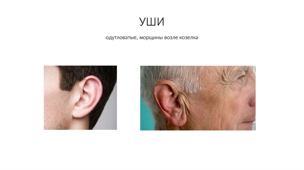 УШИ одутловатые, морщины возле козелка