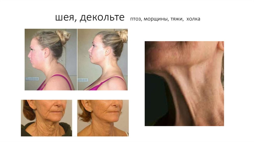 шея, декольте птоз, морщины, тяжи, холка