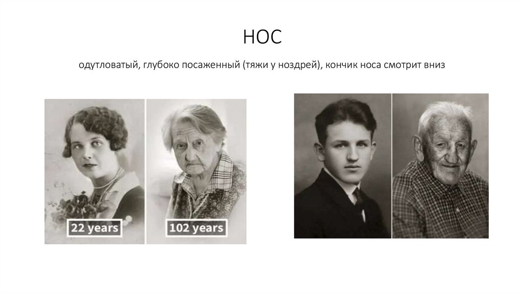 НОС одутловатый, глубоко посаженный (тяжи у ноздрей), кончик носа смотрит вниз