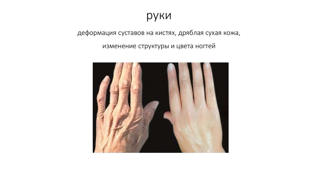 руки деформация суставов на кистях, дряблая сухая кожа, изменение структуры и цвета ногтей