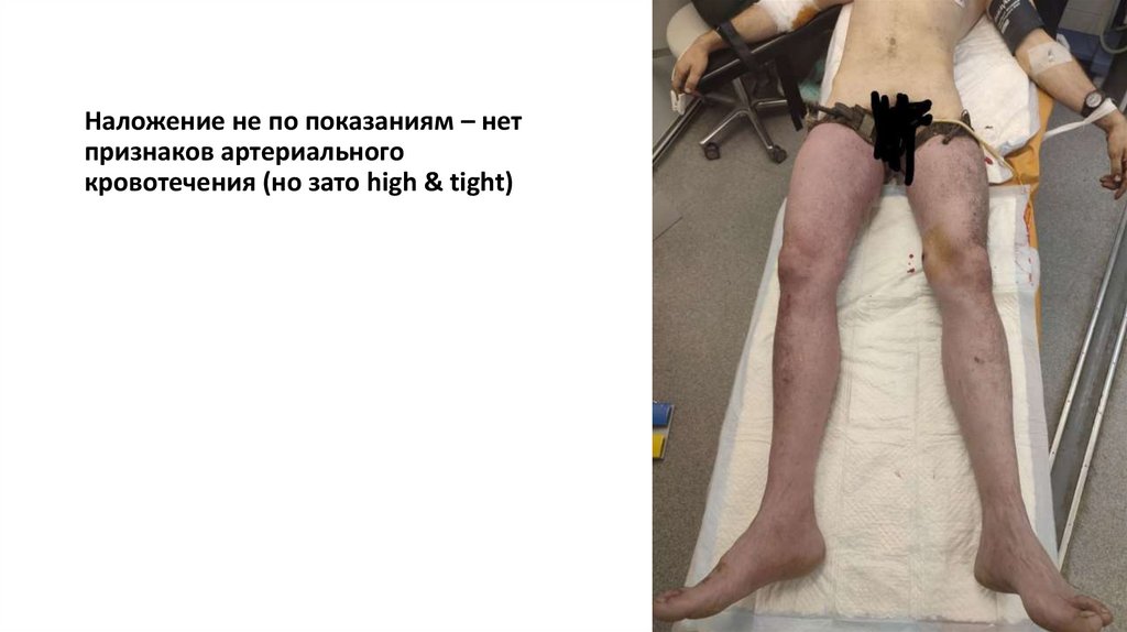 Наложение не по показаниям – нет признаков артериального кровотечения (но зато high & tight)