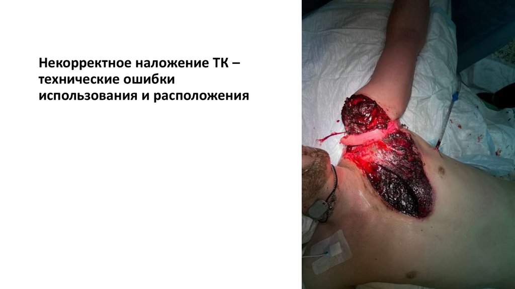 Некорректное наложение ТК – технические ошибки использования и расположения