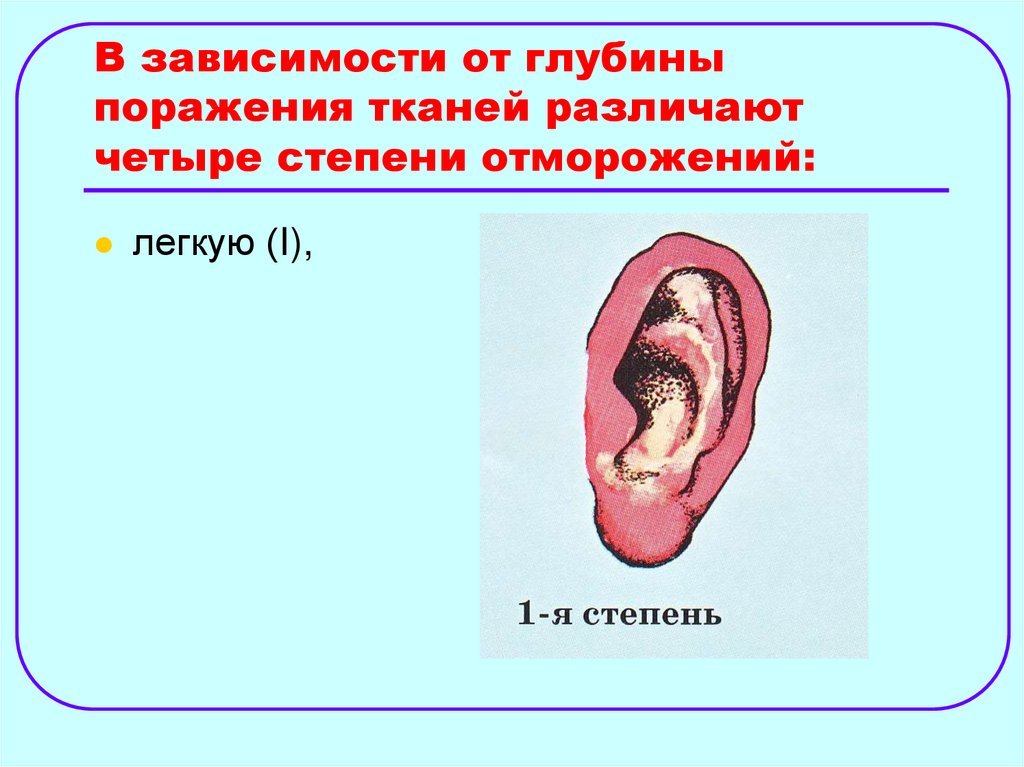 В зависимости от глубины поражения тканей различают четыре степени отморожений: