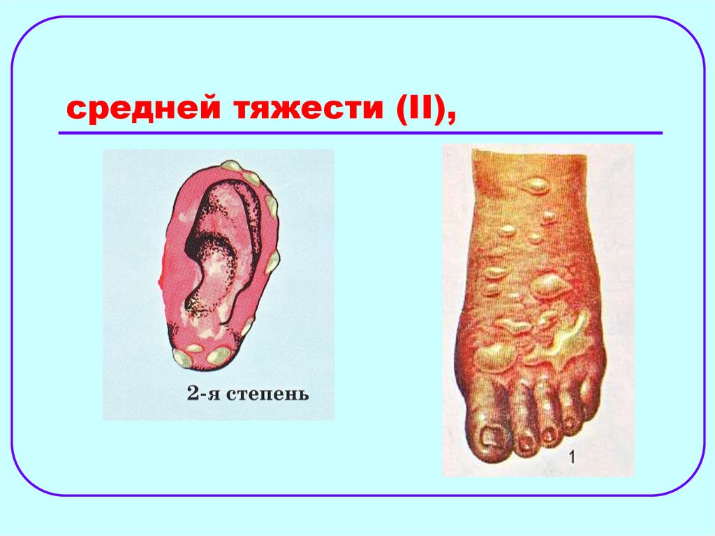 средней тяжести (II),