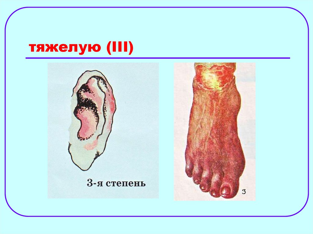 тяжелую (III)
