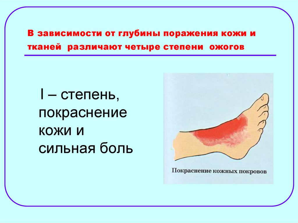 В зависимости от глубины поражения кожи и тканей различают четыре степени ожогов