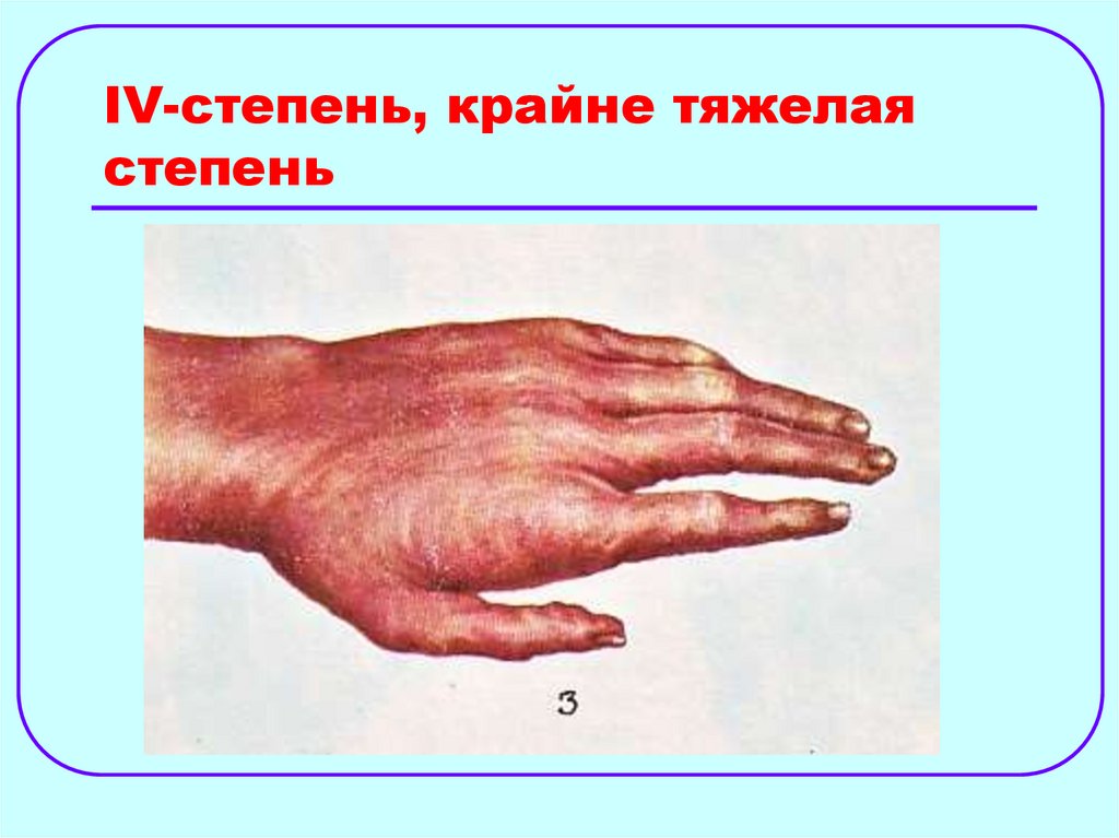 IV-степень, крайне тяжелая степень