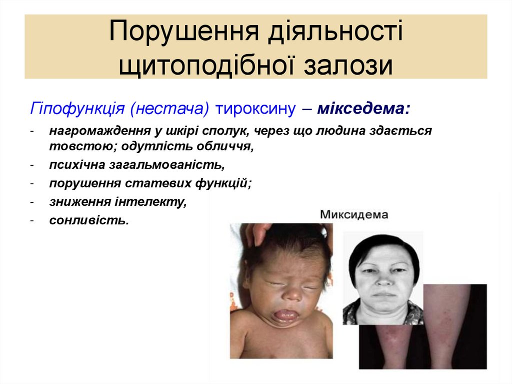 Порушення діяльності щитоподібної залози