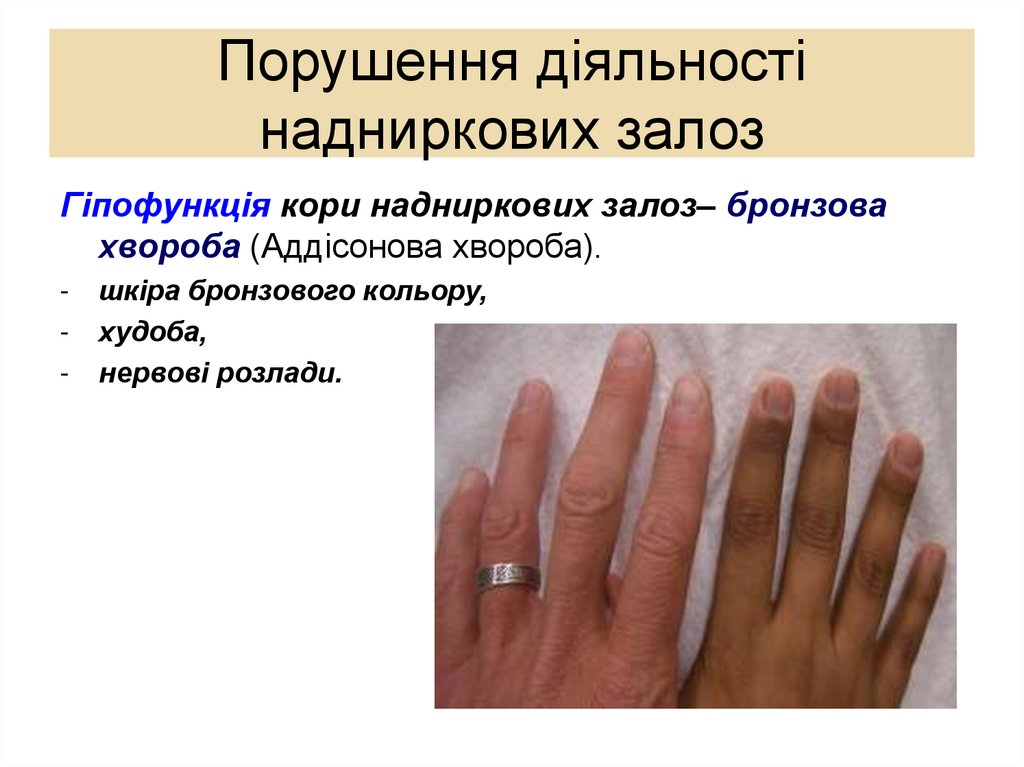 Порушення діяльності надниркових залоз