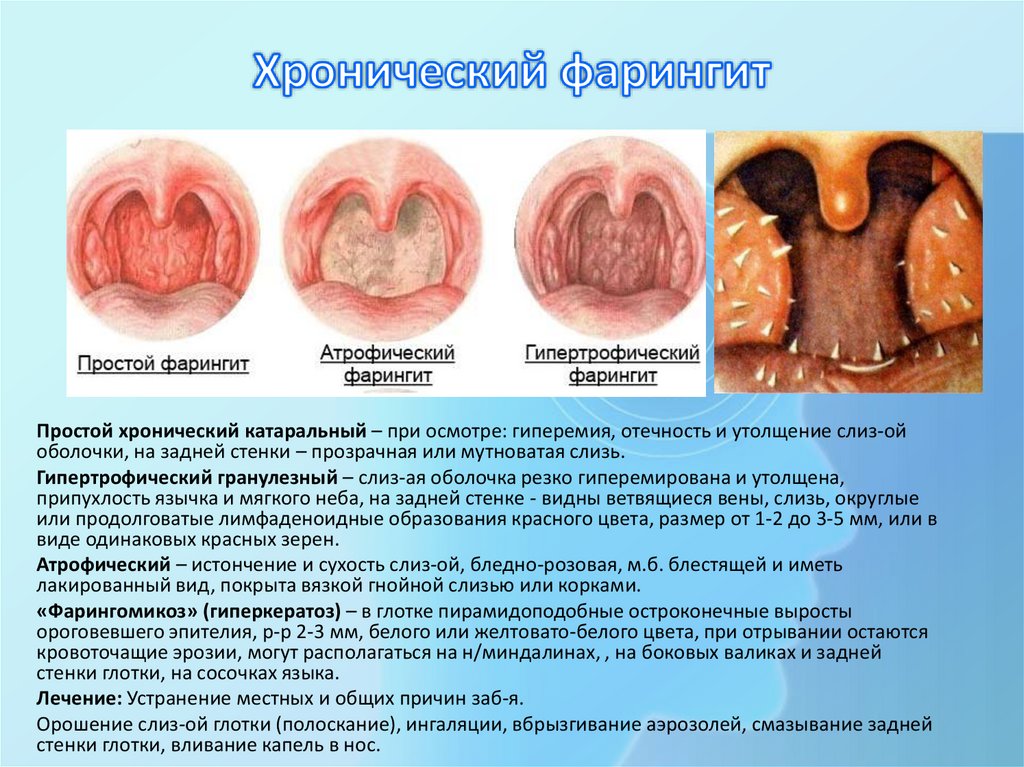 Хронический фарингит
