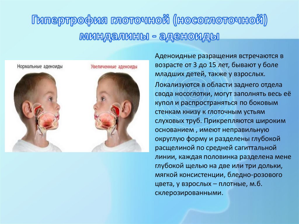 Гипертрофия глоточной (носоглоточной) миндалины - аденоиды