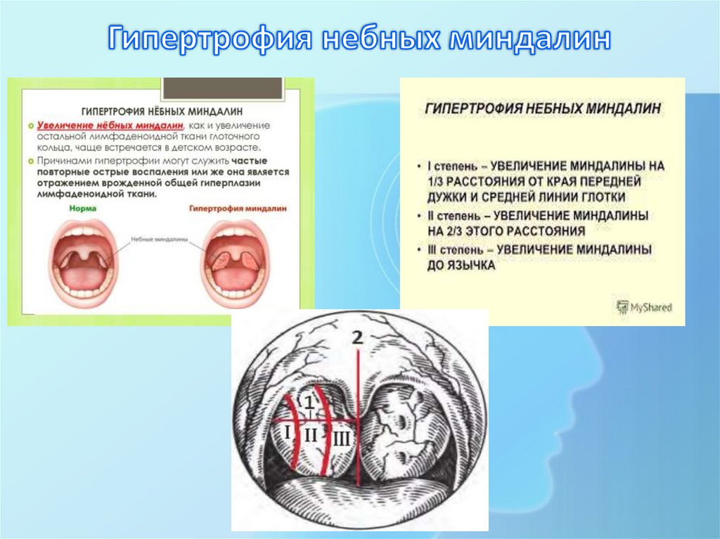 Гипертрофия небных миндалин