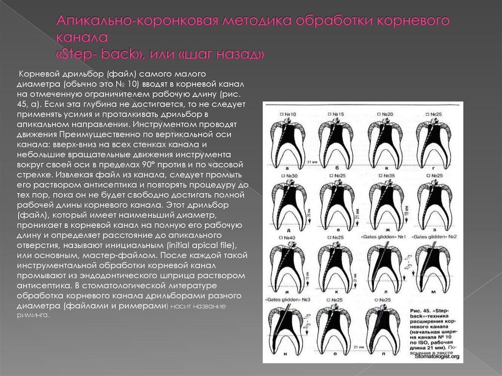Апикально-коронковая методика обработки корневого канала «Step- back», или «шаг назад»