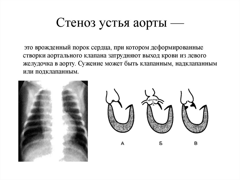 Стеноз устья аорты —