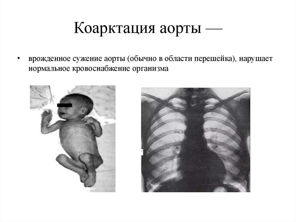 Коарктация аорты —
