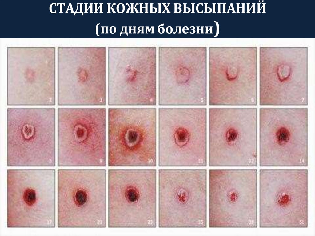 СТАДИИ КОЖНЫХ ВЫСЫПАНИЙ (по дням болезни)