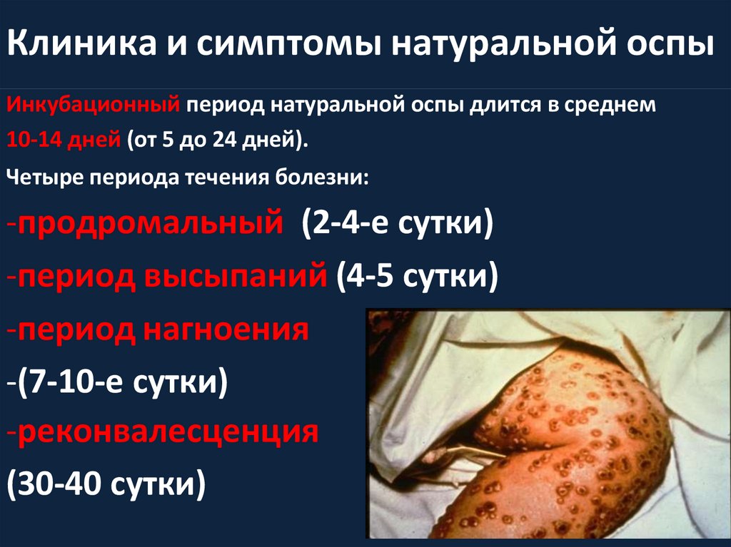 Клиника и симптомы натуральной оспы