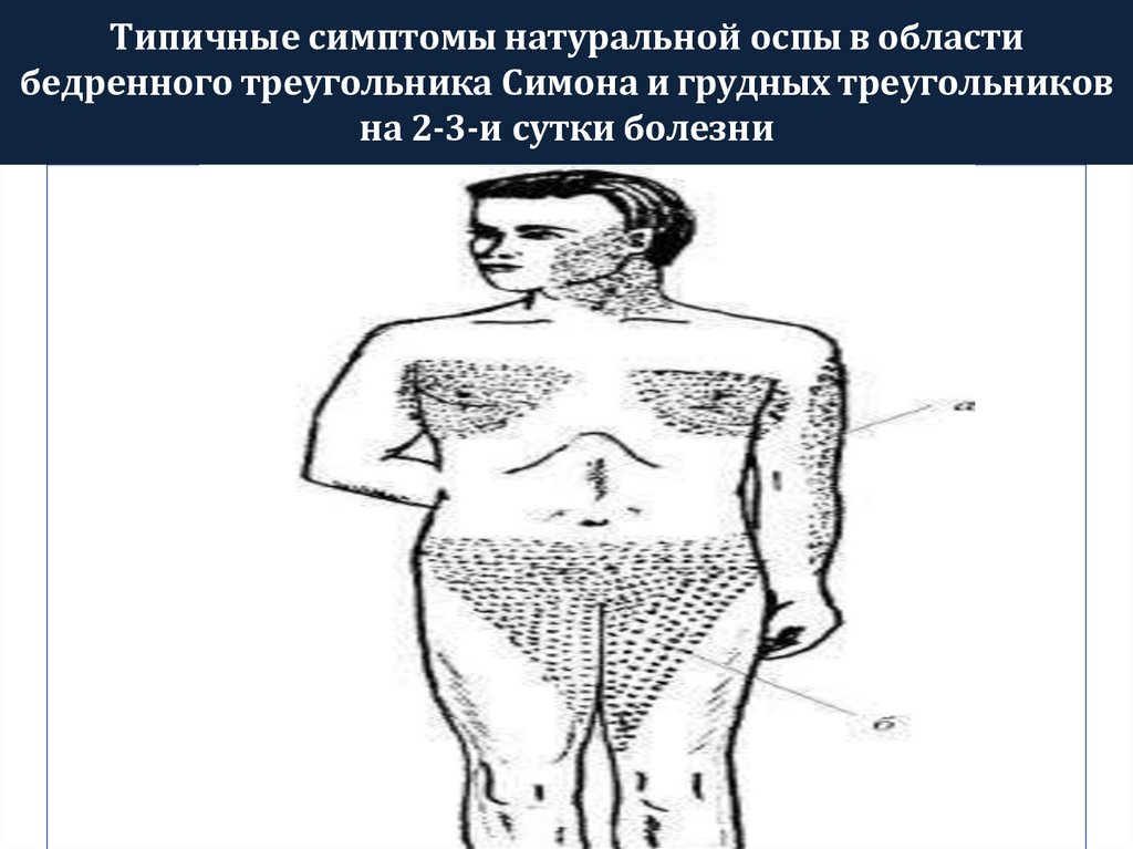 Типичные симптомы натуральной оспы в области бедренного треугольника Симона и грудных треугольников на 2-3-и сутки болезни