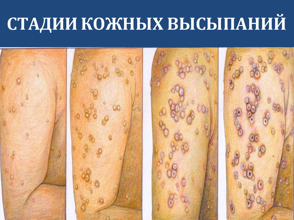 СТАДИИ КОЖНЫХ ВЫСЫПАНИЙ