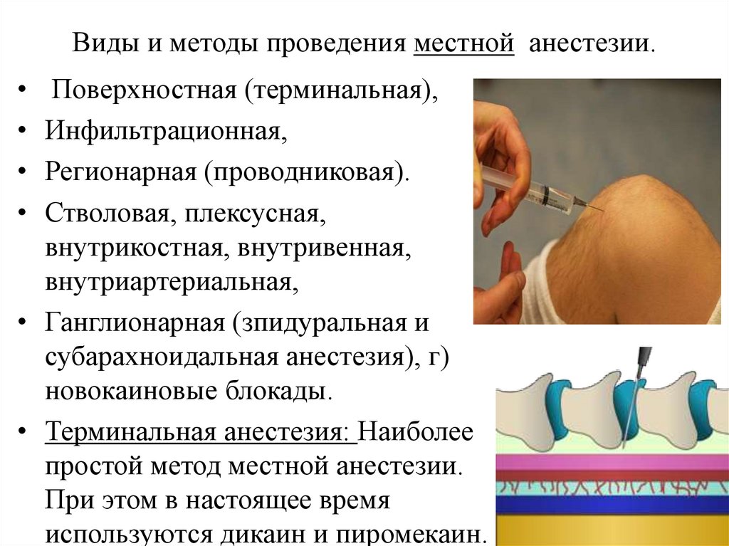 Виды и методы проведения местной анестезии.