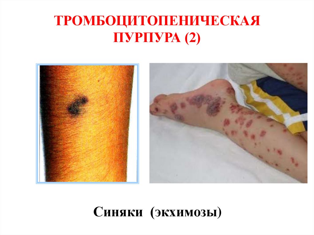 ТРОМБОЦИТОПЕНИЧЕСКАЯ ПУРПУРА (2)