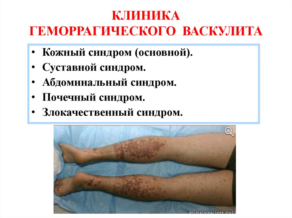 КЛИНИКА ГЕМОРРАГИЧЕСКОГО ВАСКУЛИТА