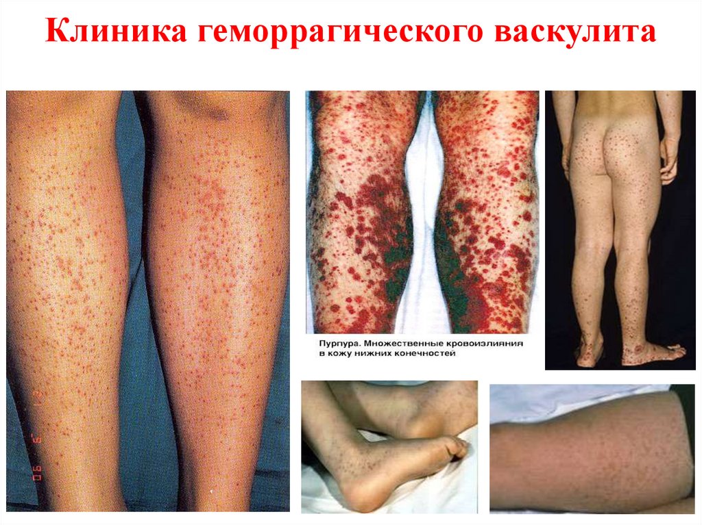 Клиника геморрагического васкулита