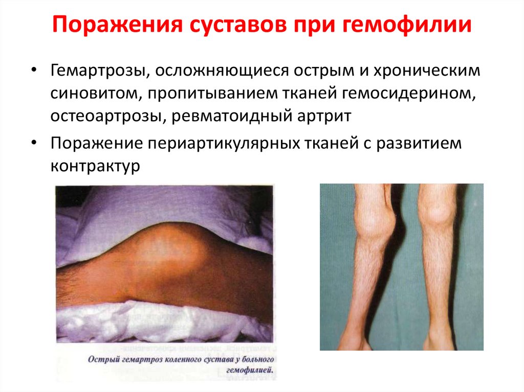 Поражения суставов при гемофилии