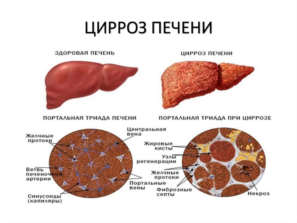 ЦИРРОЗ ПЕЧЕНИ