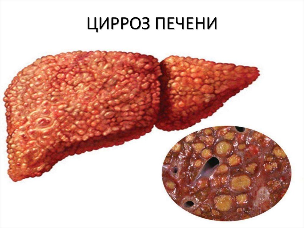ЦИРРОЗ ПЕЧЕНИ