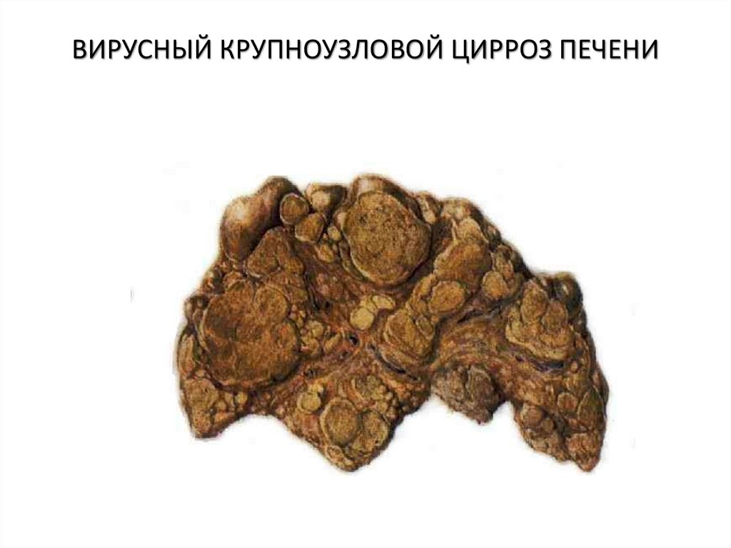 ВИРУСНЫЙ КРУПНОУЗЛОВОЙ ЦИРРОЗ ПЕЧЕНИ
