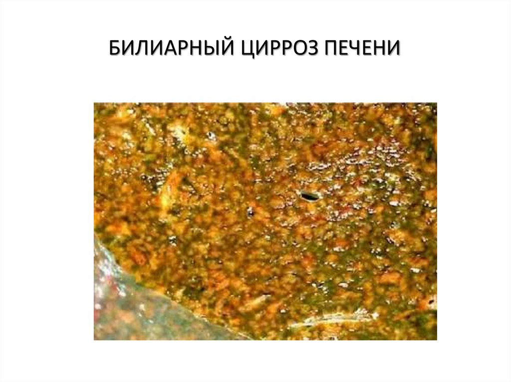 БИЛИАРНЫЙ ЦИРРОЗ ПЕЧЕНИ