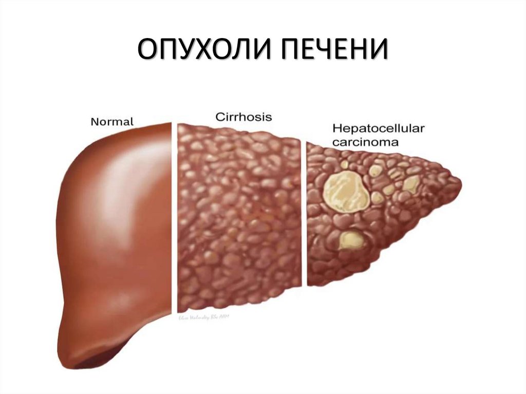 ОПУХОЛИ ПЕЧЕНИ
