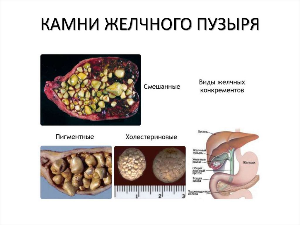 КАМНИ ЖЕЛЧНОГО ПУЗЫРЯ