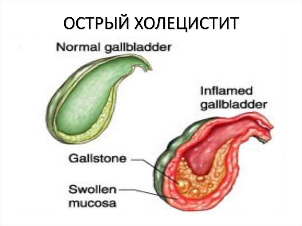 ОСТРЫЙ ХОЛЕЦИСТИТ
