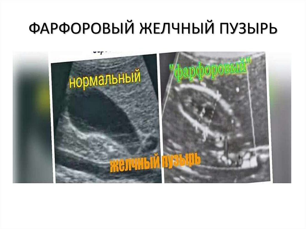 ФАРФОРОВЫЙ ЖЕЛЧНЫЙ ПУЗЫРЬ