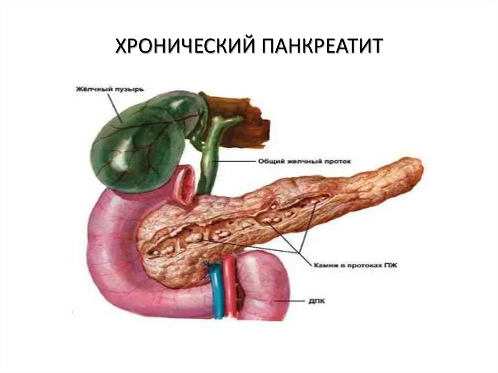 ХРОНИЧЕСКИЙ ПАНКРЕАТИТ