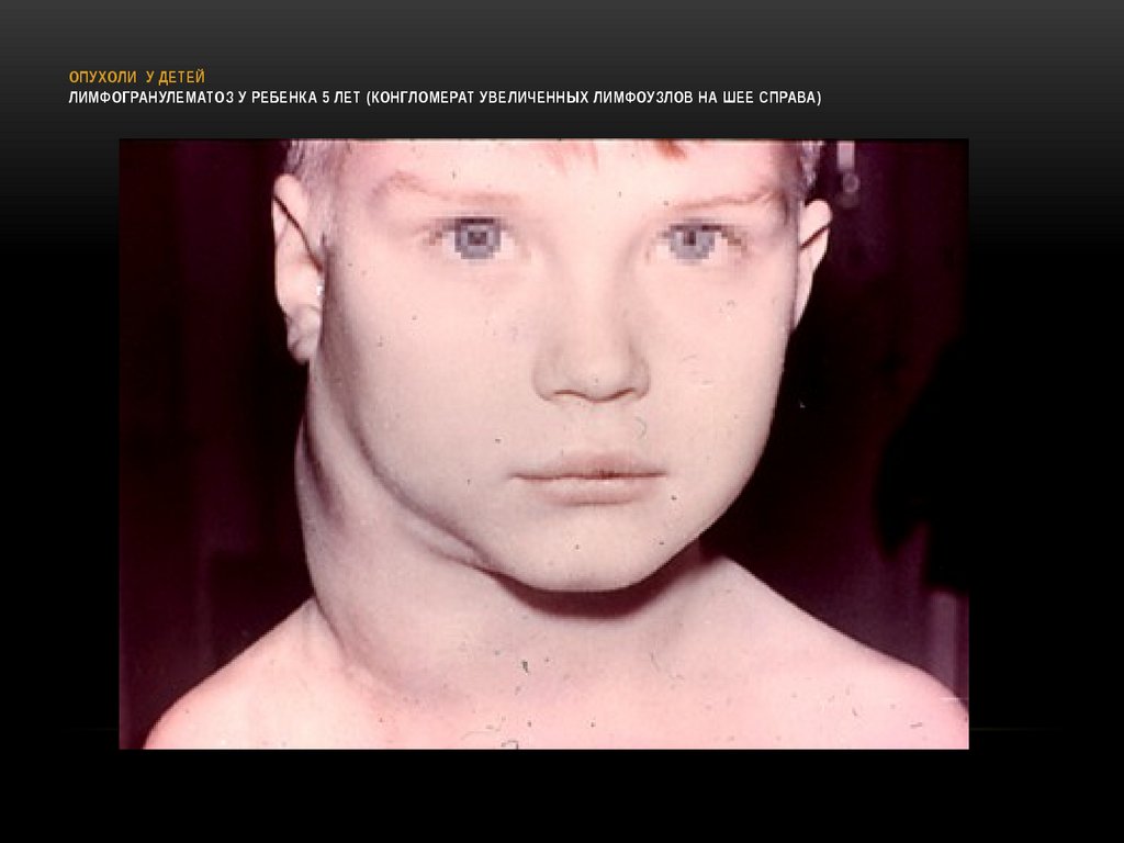 ОПУХОЛИ У ДЕТЕЙ Лимфогранулематоз у ребенка 5 лет (конгломерат увеличенных лимфоузлов на шее справа)