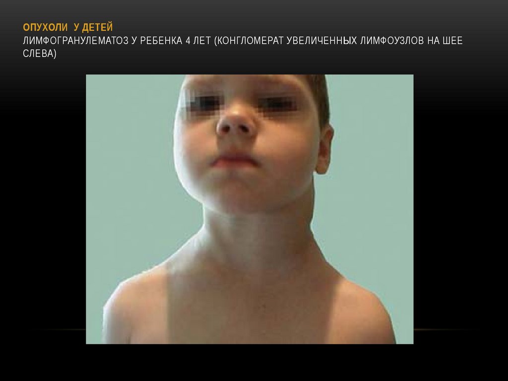 ОПУХОЛИ У ДЕТЕЙ Лимфогранулематоз у ребенка 4 лет (конгломерат увеличенных лимфоузлов на шее слева)