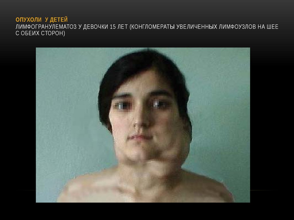 ОПУХОЛИ У ДЕТЕЙ Лимфогранулематоз у девочки 15 лет (конгломераты увеличенных лимфоузлов на шее с обеих сторон)