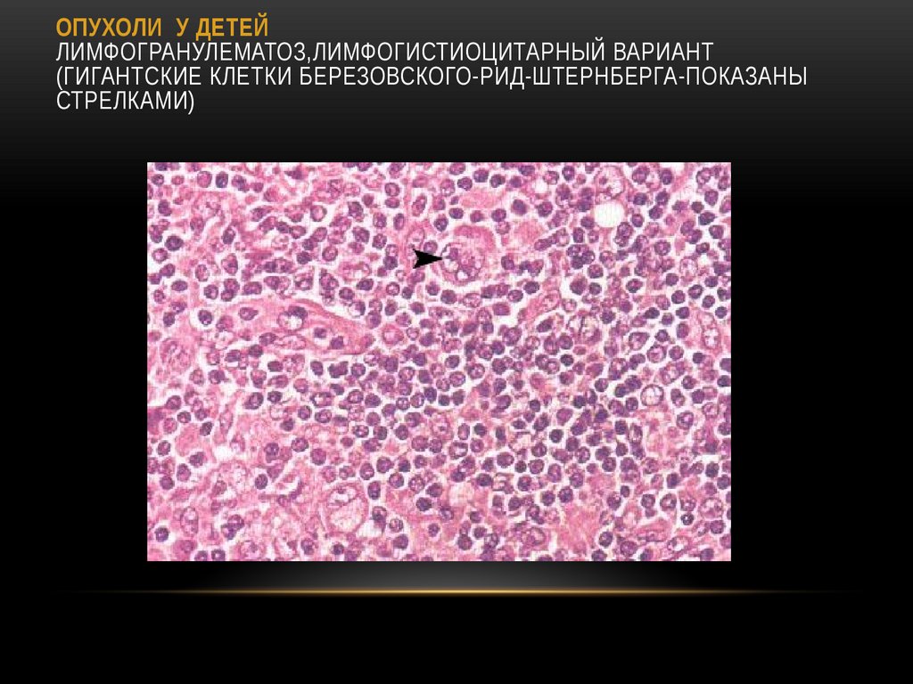 ОПУХОЛИ У ДЕТЕЙ Лимфогранулематоз,лимфогистиоцитарный вариант (гигантские клетки Березовского-Рид-Штернберга-показаны