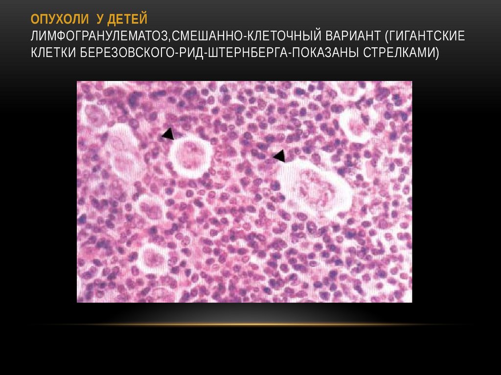 ОПУХОЛИ У ДЕТЕЙ Лимфогранулематоз,смешанно-клеточный вариант (гигантские клетки Березовского-Рид-Штернберга-показаны стрелками)
