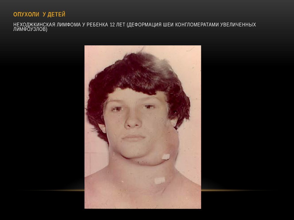 ОПУХОЛИ У ДЕТЕЙ Неходжкинская лимфома у ребенка 12 лет (деформация шеи конгломератами увеличенных лимфоузлов)