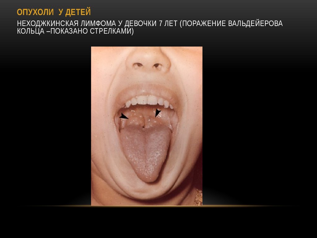 ОПУХОЛИ У ДЕТЕЙ Неходжкинская лимфома у девочки 7 лет (поражение Вальдейерова кольца –показано стрелками)