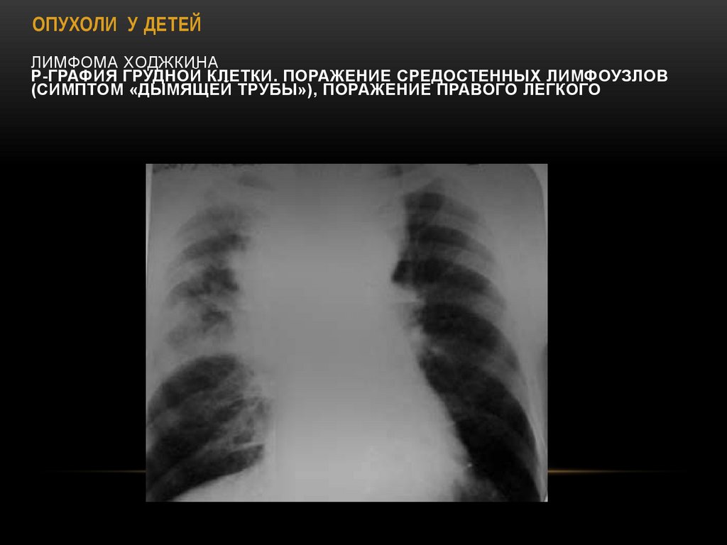 Лимфома Ходжкина Р-графия грудной клетки. Поражение средостенных лимфоузлов (симптом «дымящей трубы»), поражение правого