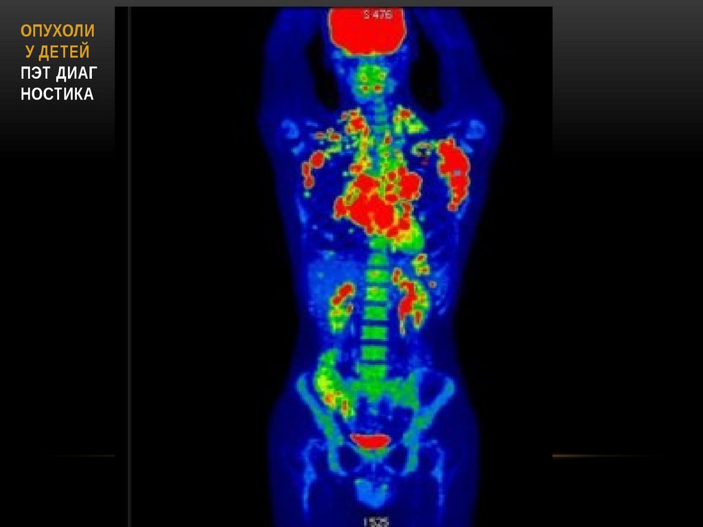 ОПУХОЛИ У ДЕТЕЙ ПЭТ диаг ностика